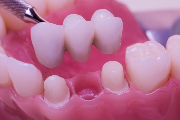 What To Expect During A Dental Bridge Procedure