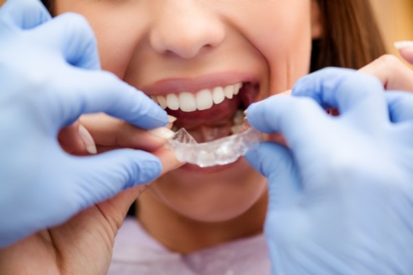 What To Discuss At A Dental Consultation About Invisalign